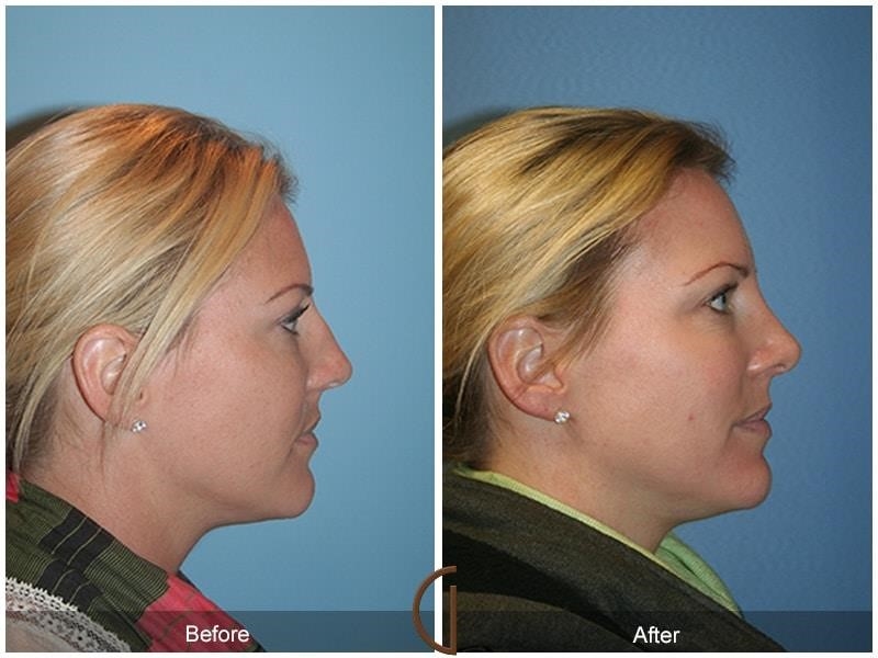 rhinoplasty expert