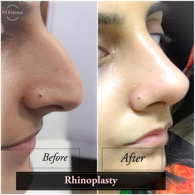 rhinoplasty expert