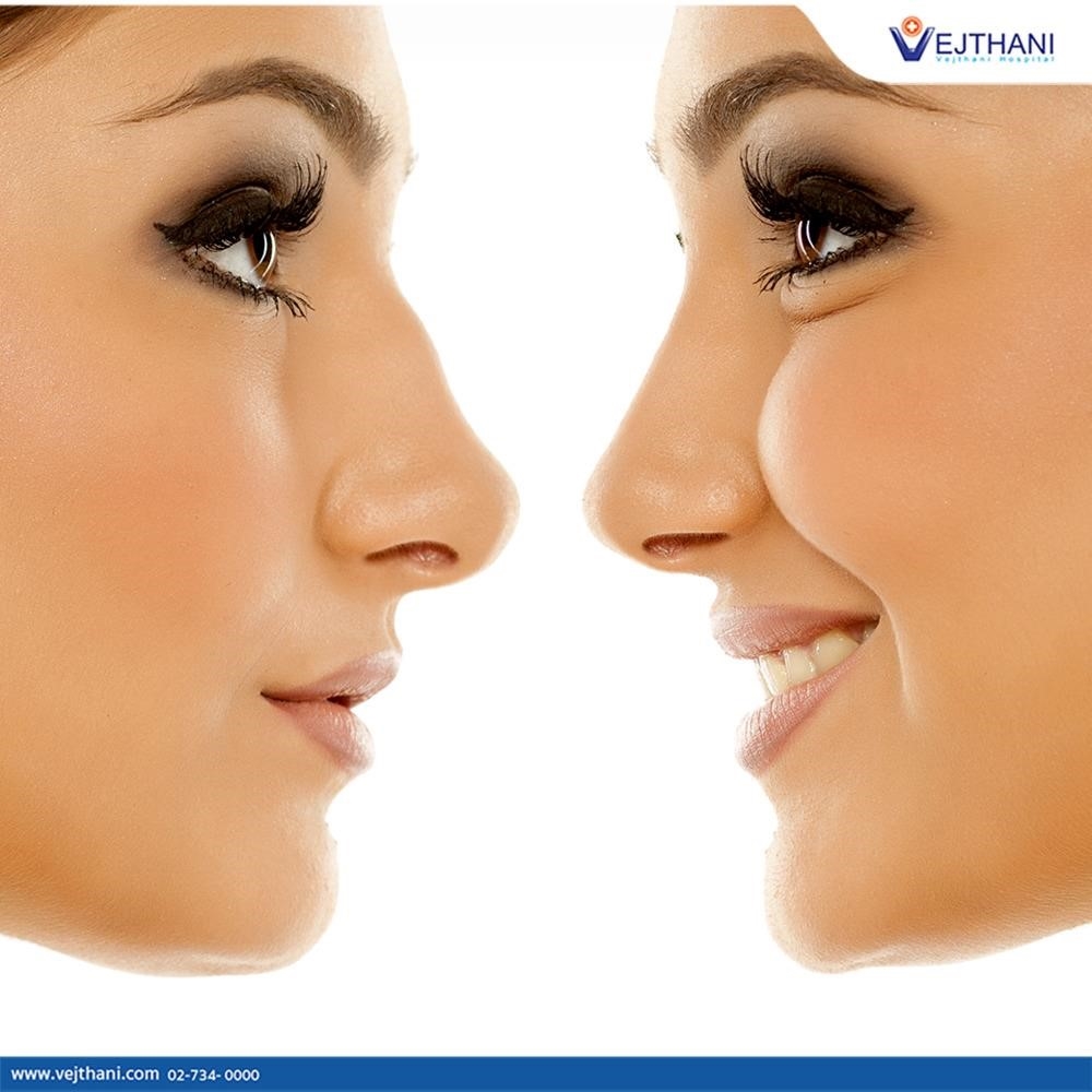 rhinoplasty surgeons